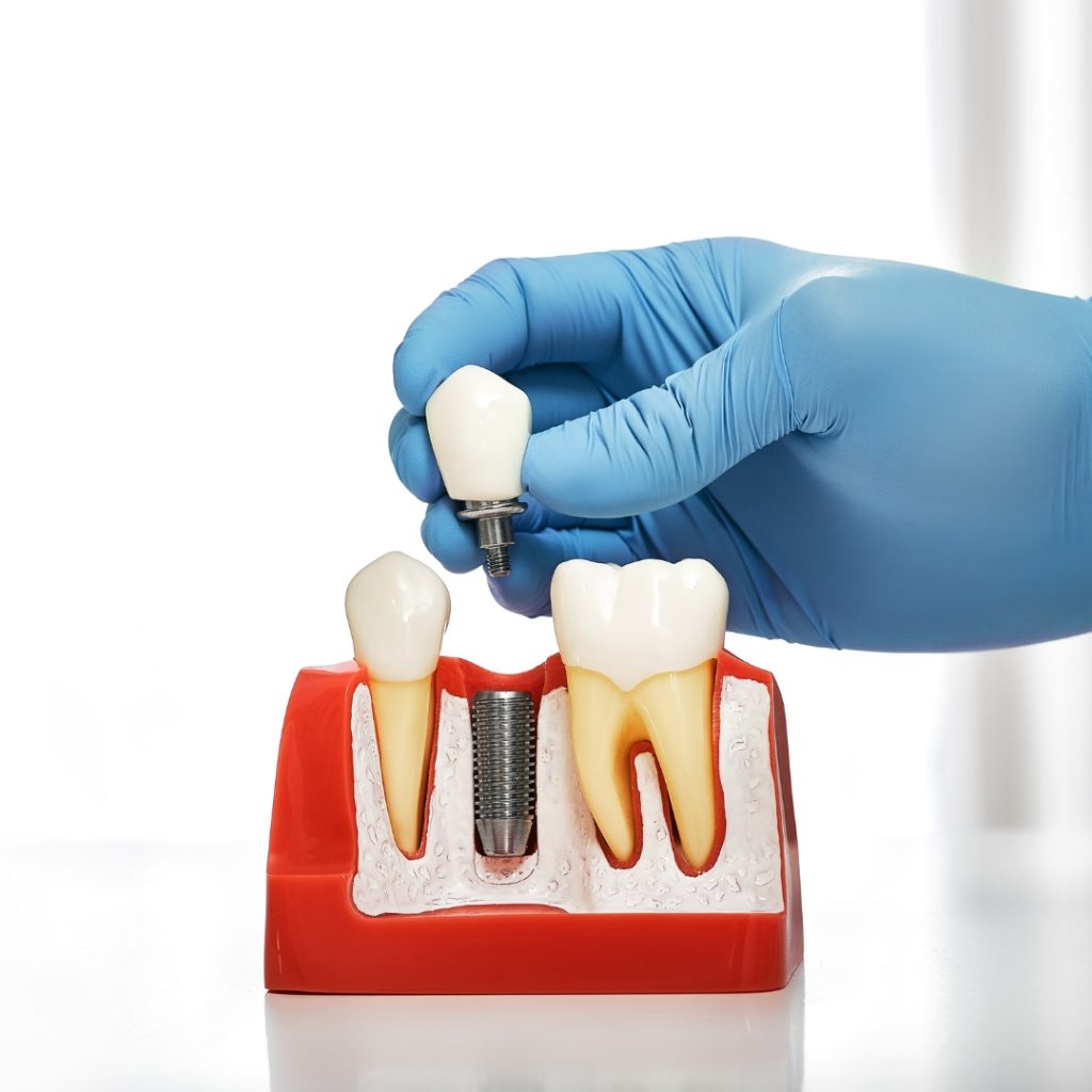 Model of a dental implant beside natural teeth