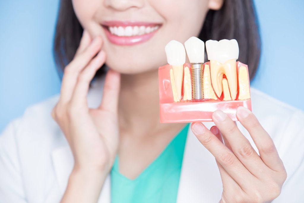 Dental professional holding a model of a dental implant