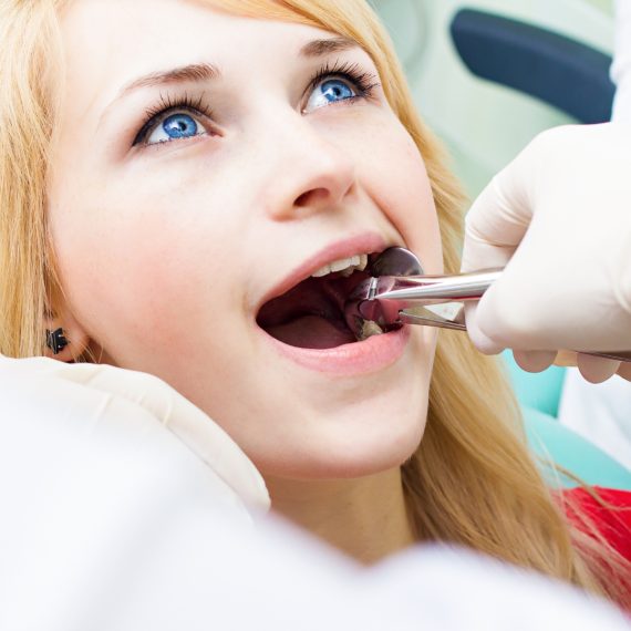 Wisdom Teeth Extraction